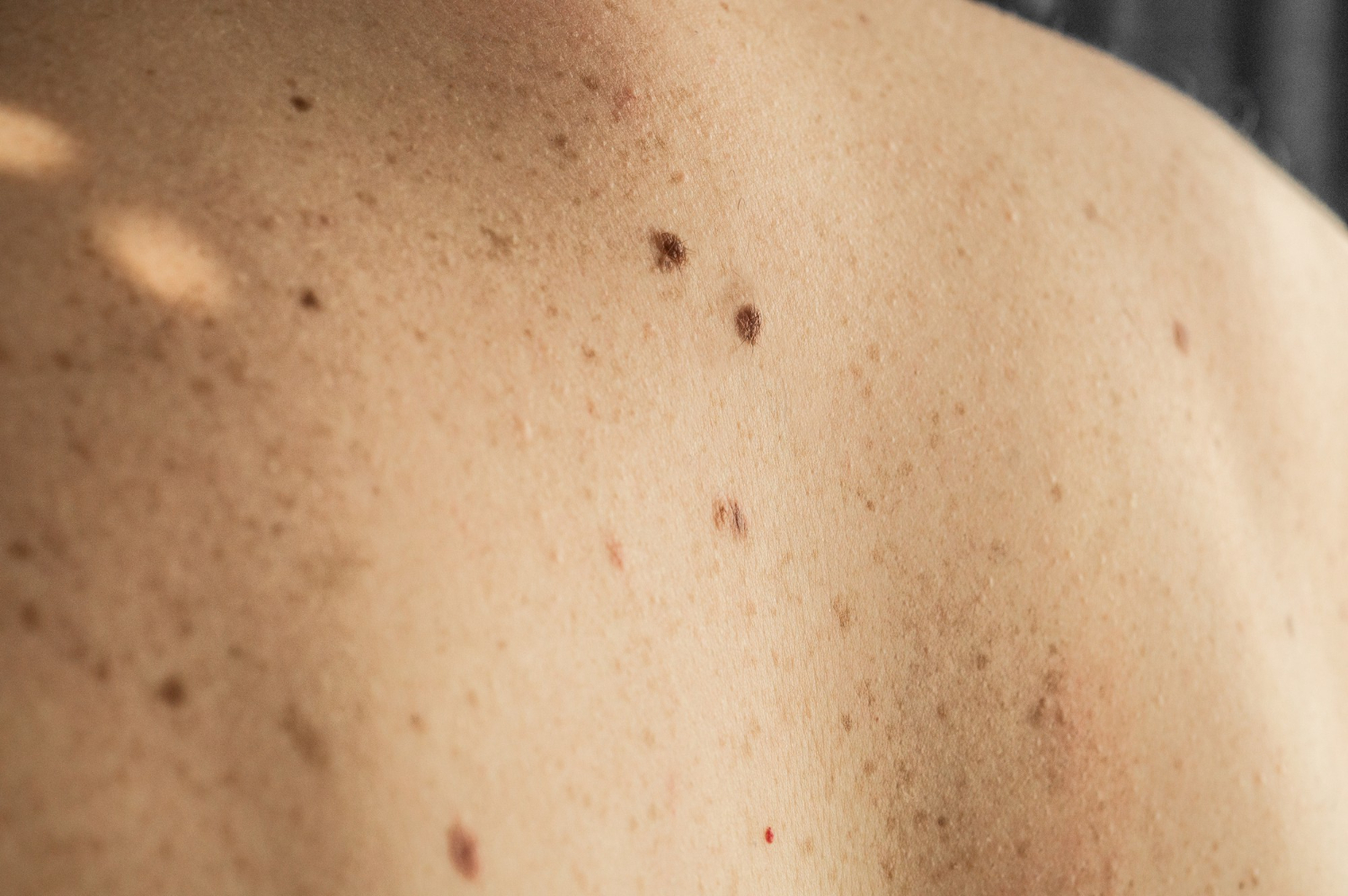 Dermatología quirúrgica